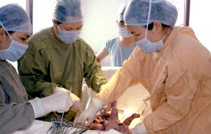 剖腹產手術 (67) 