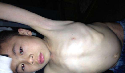 寶寶缺鈣雞胸圖 (49) 