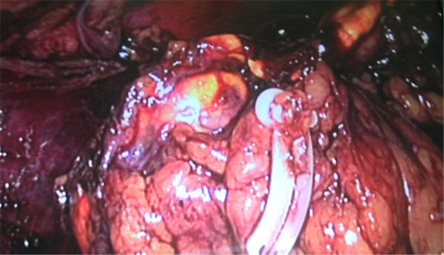 左側腎上腺腫瘤