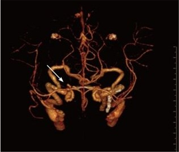 蛛網膜下腔出血引發腦血管痙攣