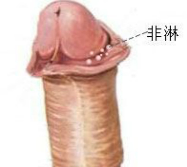 生殖器白色念珠菌感染 