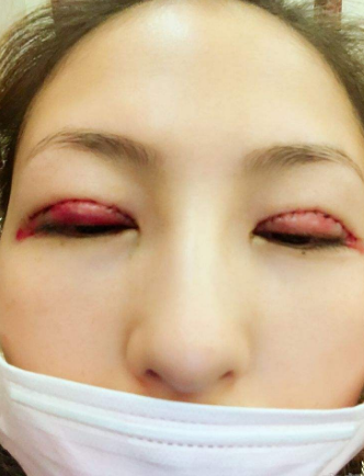 割雙眼皮