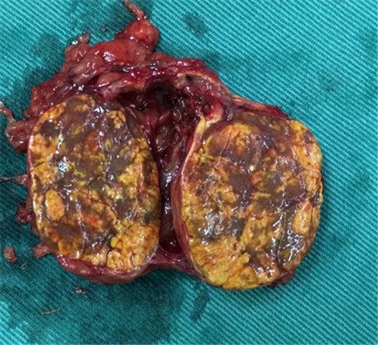 微創切除的腎上腺腫瘤