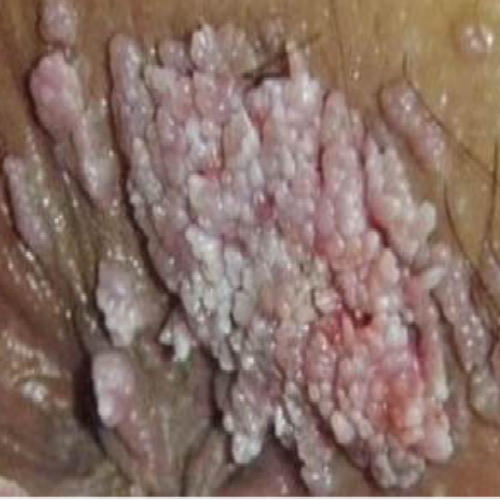 嚴重外陰溼疹的