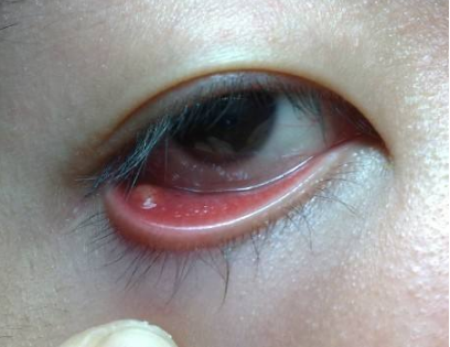 眼睛麥粒腫初期