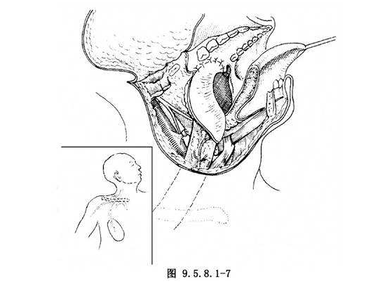 扁桃體癌圖  (69) 