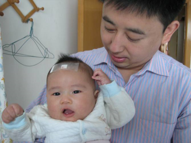 先天性喉喘鳴治療後