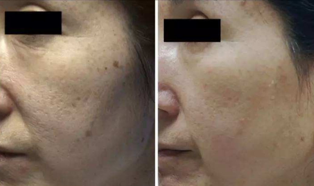 面部皮膚老化的