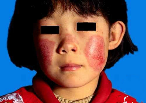 系統性紅斑狼瘡診斷標準 (5) 