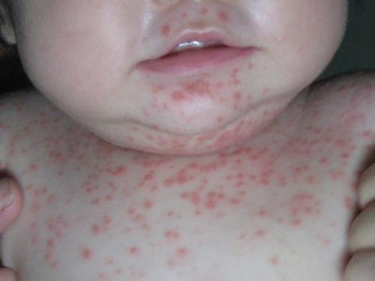 小兒猩紅熱症狀