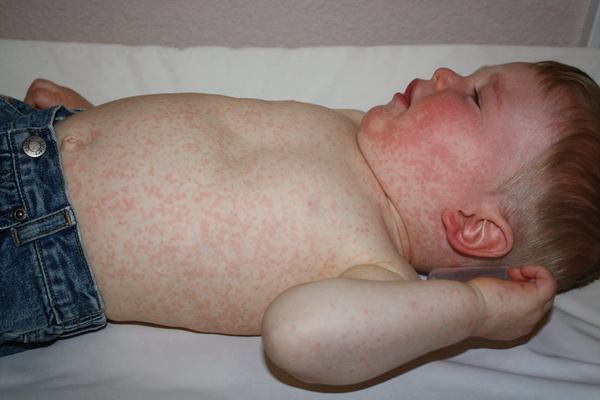 嬰兒蕁麻疹 (8) 