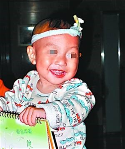 治療後的先天性喉喘鳴