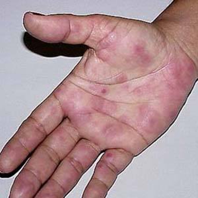 紅斑結節圖 (61) 