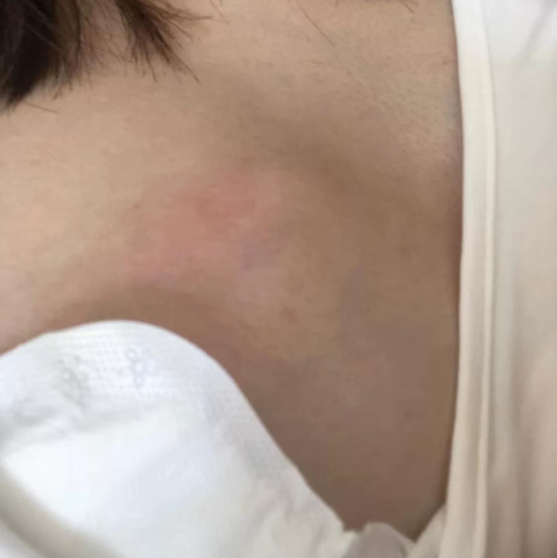 早期乳腺炎症狀