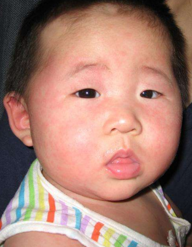 臉上皮膚過敏症狀