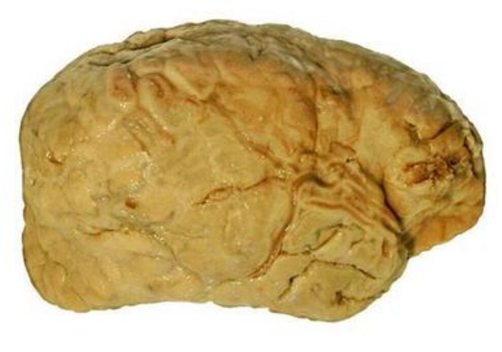 腦膜炎細菌性的腦部的