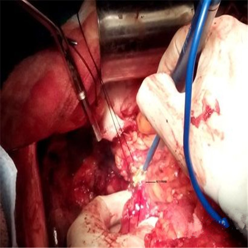 潰瘍性結腸炎手術中