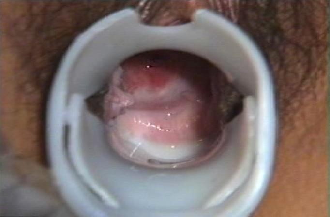 黴菌陰炎症狀 (45) 