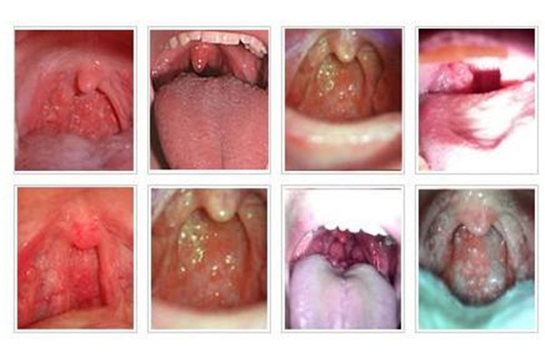 喉部淋巴濾泡增生 (41) 