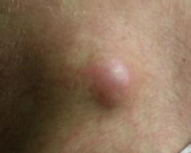 少年淋巴結核的