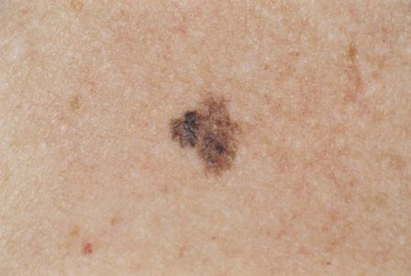 黑痣癌變的徵兆