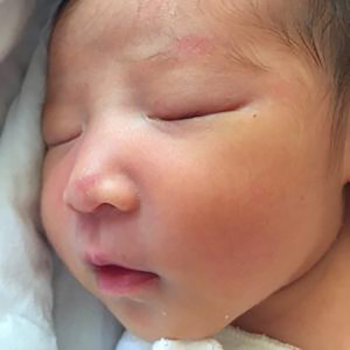 新生兒甲狀腺腫大