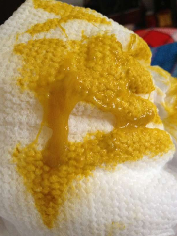 新生兒腹瀉大便