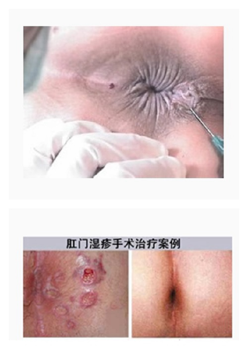 肛周溼疹的治療要點