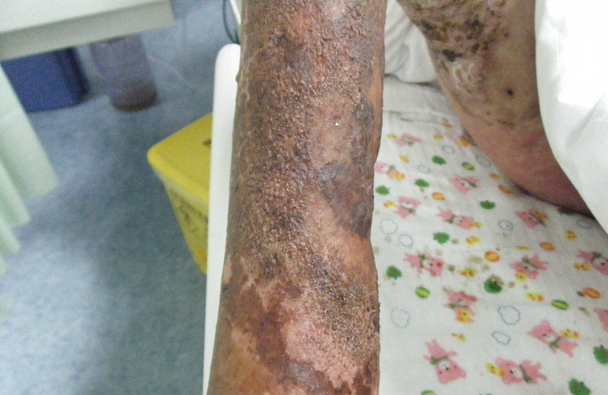 特別嚴重的放射性皮炎