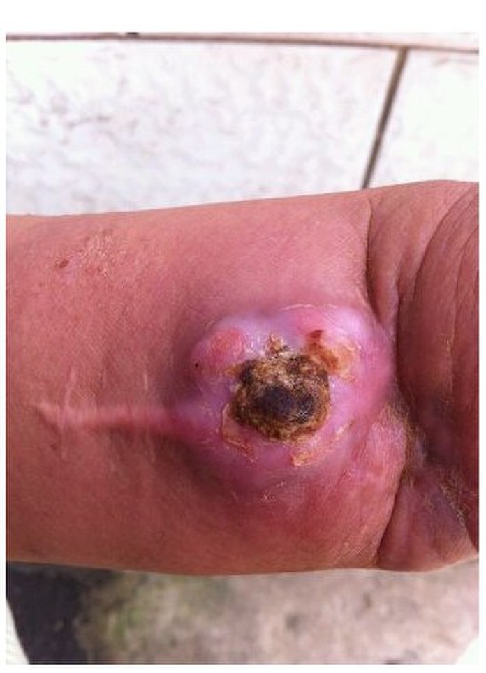 腱鞘炎治療不當的