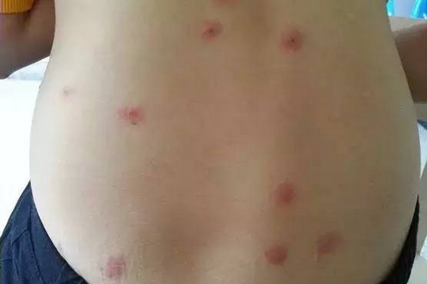 背部夏季皮炎症狀