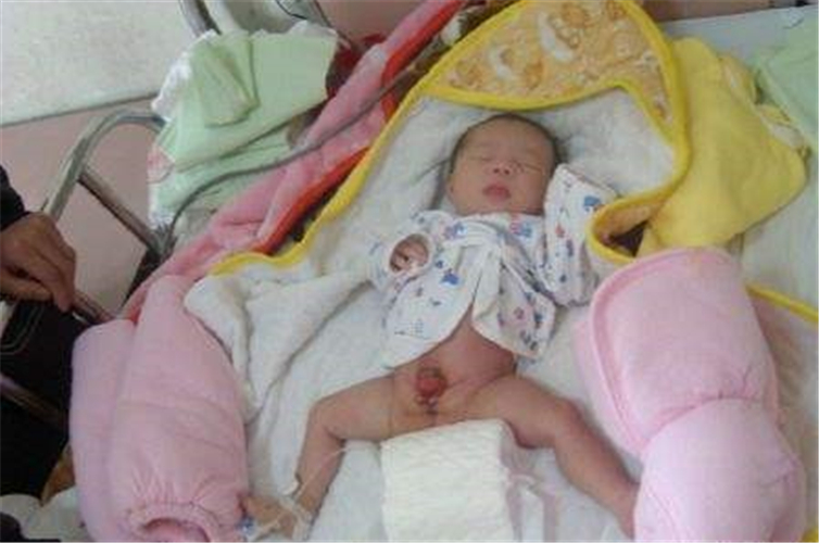 男嬰男性假兩性畸形的