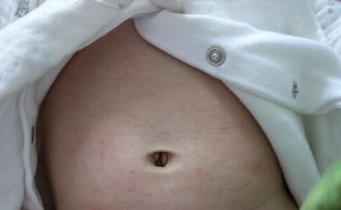 小兒急疹的症狀 (35) 