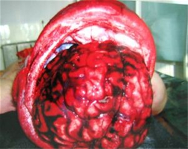 腦血管痙攣危害