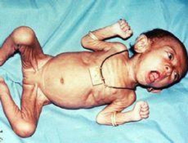 新生兒破傷風臨床表現