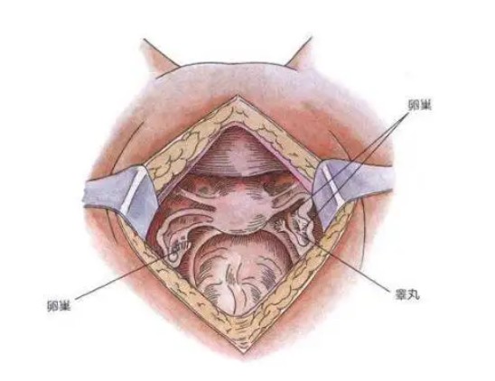嬰兒的男性假兩性畸形