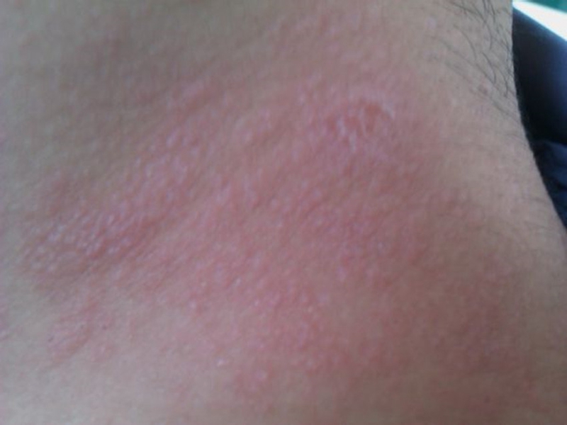 藥物性皮炎脖子局部大面積紅色區域