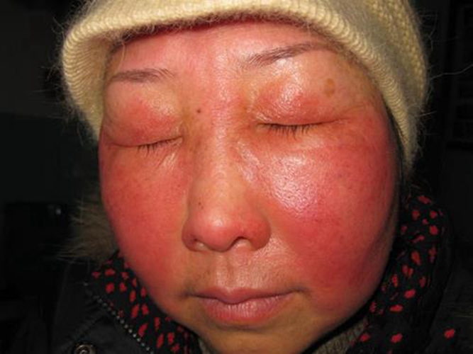 面部接觸性皮炎