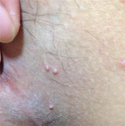 絨毛假性溼疣男