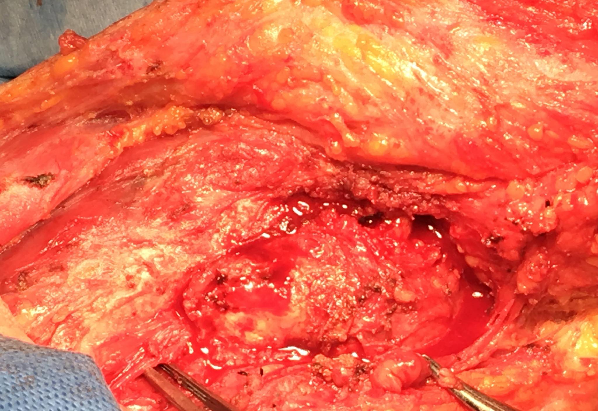 切下來的喉腫瘤