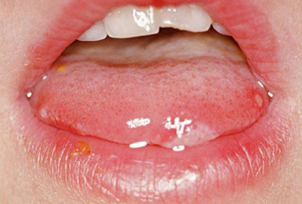 嘴上長皰疹 (53) 