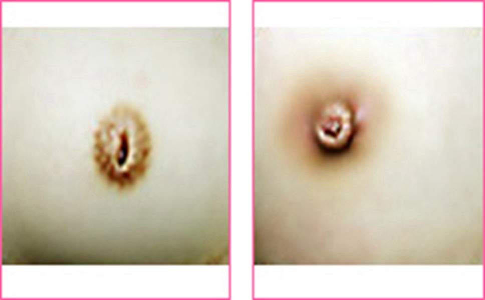 新生兒乳頭內陷