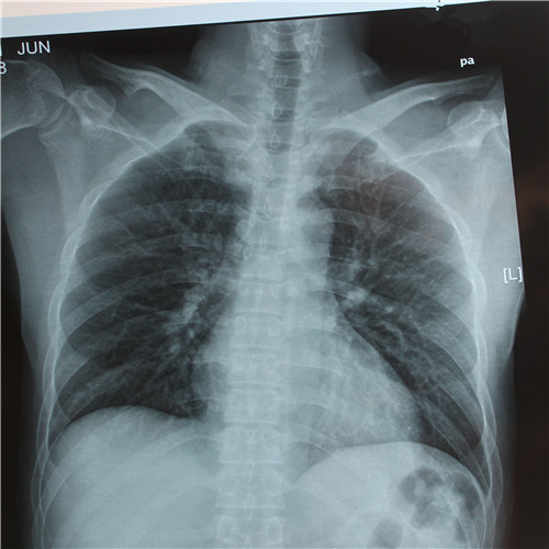 呼吸道感染胸片檢查