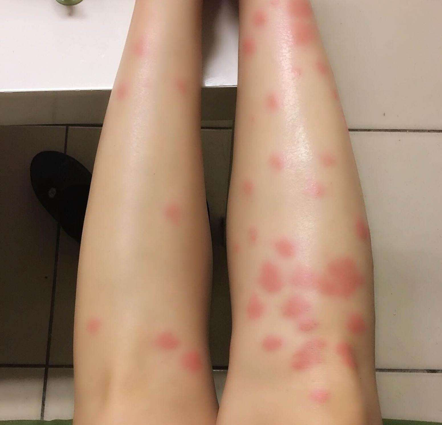 被跳蚤咬的症狀