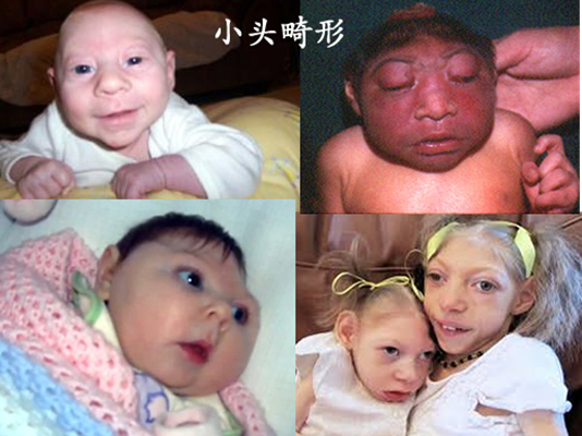 小頭畸形 (59) 