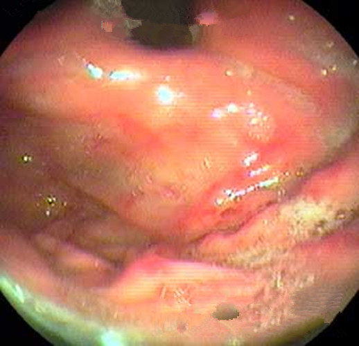 淺表型糜爛出血慢性胃炎