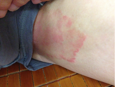 體股癬初期現象