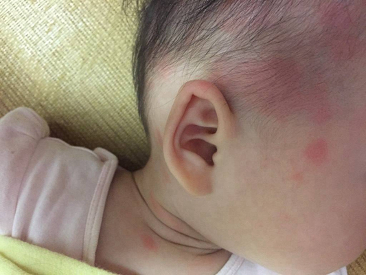嬰兒風疹