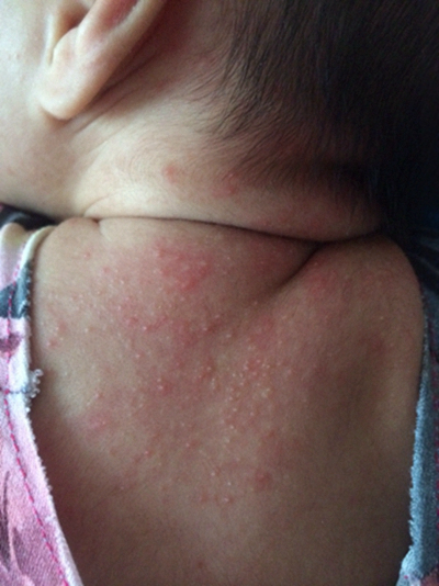 新生兒胎毒的症狀