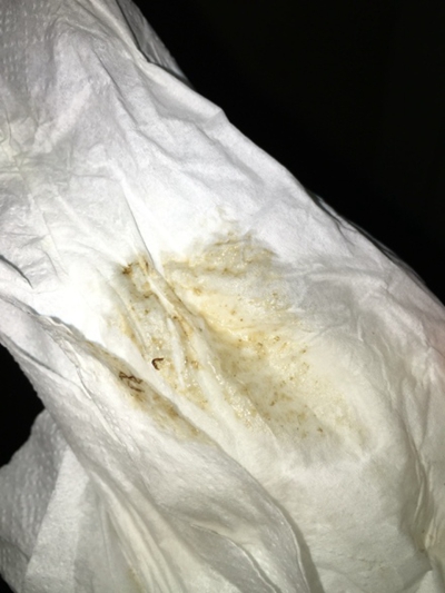 先兆流產分泌物